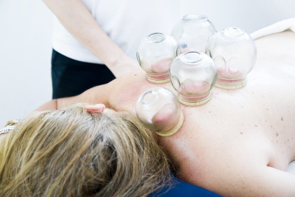 Cupping therapy Basingstoke